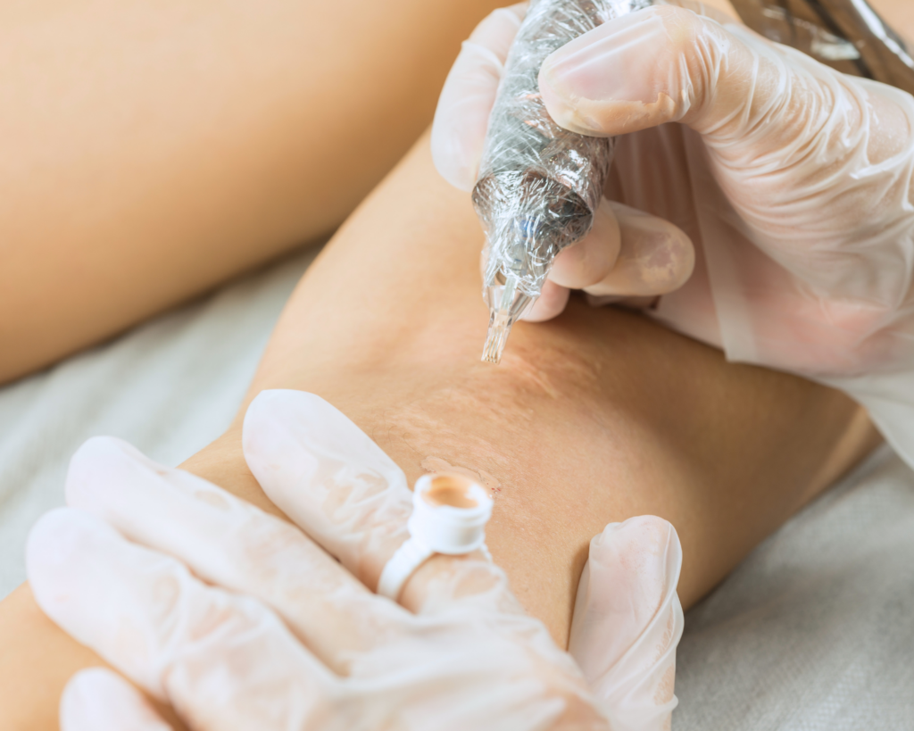 Scar camouflage tattoo procedure being performed to blend and conceal the appearance of a healed scar using custom pigment matching.