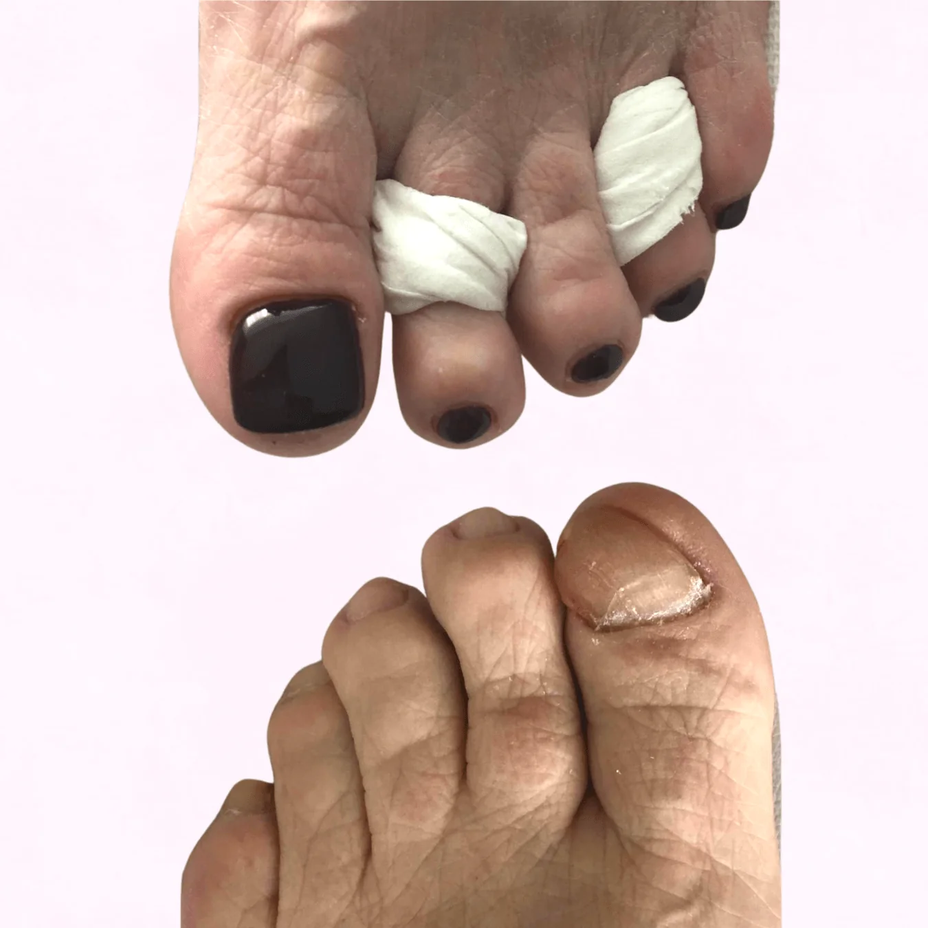 nail reconstruction before and after 2